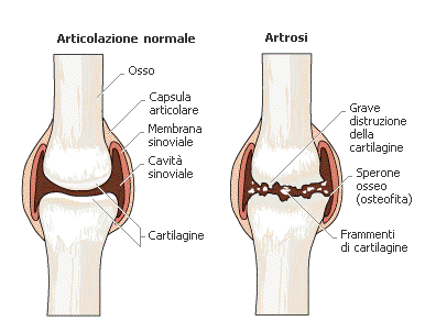 artrosi-salute delle articolazioni-marta-simonetto-naturopata-busto-arsizio-centro-di-naturopatia-mozzate (1)